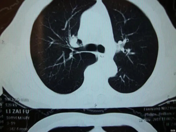 肺部CT检查多少钱一次，200-300元左右（增强ct500