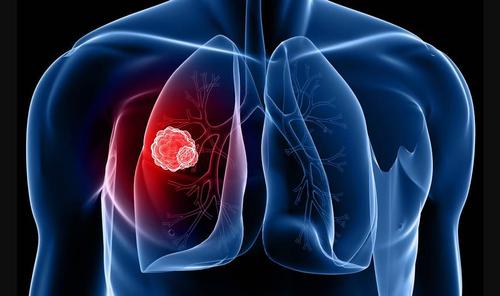  三个征兆说明已有肺癌，胸闷长期咳嗽且痰中带血