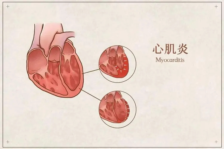 新冠引起的心肌炎表现症状有哪些，心跳过快或过慢等4个信号