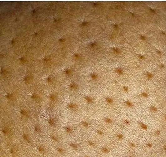 乳腺癌橘子皮样的褶皱图片，乳房皮肤坑坑洼洼像像橘子皮