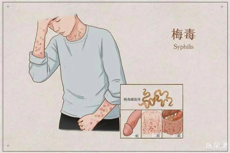 男性各种性疾病的症状图片，传染性软疣/生zhi器疱疹/梅毒等