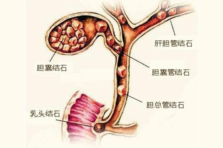 胆结石最怕三个蔬菜水果，刺激性/易产生气体/富含草酸这三类的