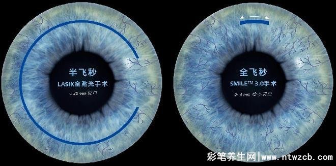 全飞秒手术做近视价格，一般要12000-30000元
