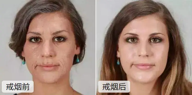 戒烟一个月后脸的变化，变年轻/有精神（吸烟戒烟脸色前后图片）