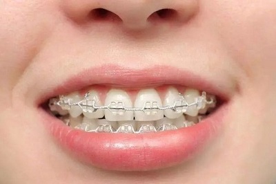 牙齿矫正一般多少钱