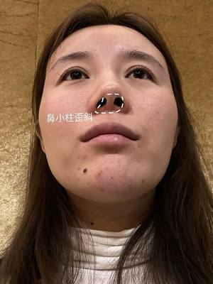 整形外科整鼻子需要多少钱,韩国整鼻子需要多少钱