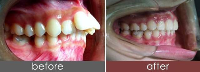 牙科带牙套多少钱,牙套多少钱一套?