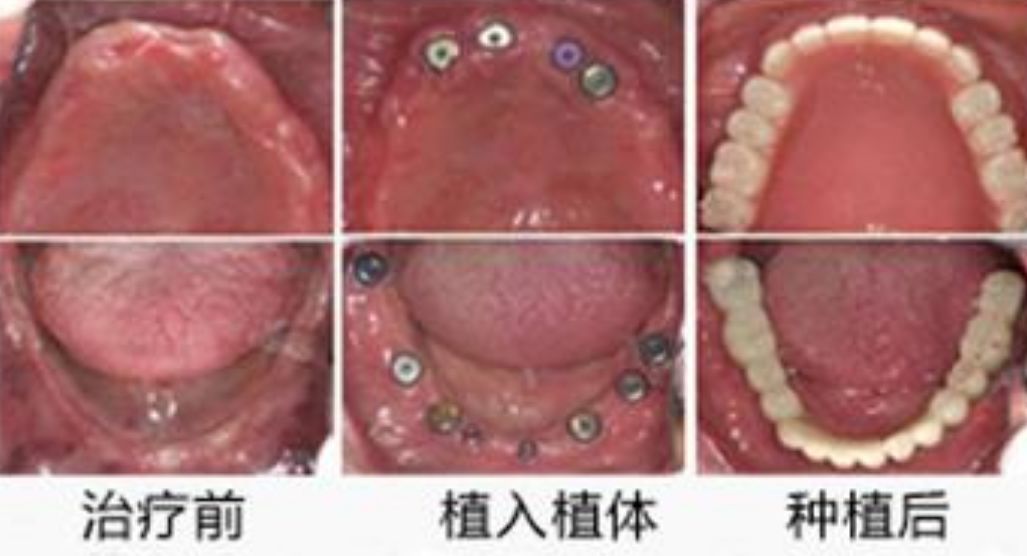 老年人做满口牙多少钱,老年人全口义齿价格表