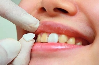 去看牙医洗牙齿多少钱,在医院洗牙齿多少钱