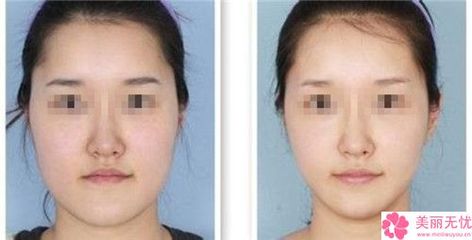 汉字脸截骨术一般要多少钱,矫正大小脸要多少钱?