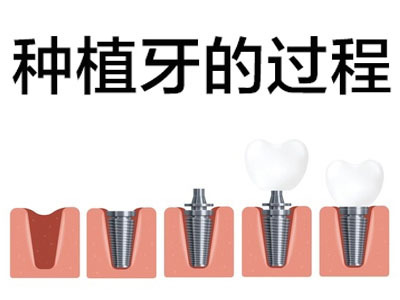 上海医院种植牙一颗多少钱,北京口腔医院种植牙一颗多少钱