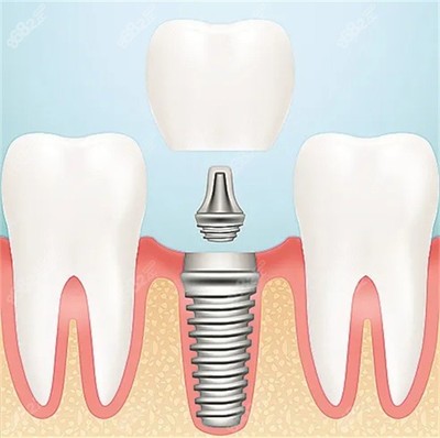 种植牙多少钱