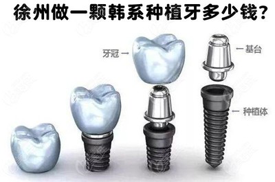 种植牙大概多少钱一颗