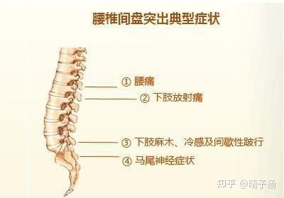 腰间盘轻微突出可以恢复吗